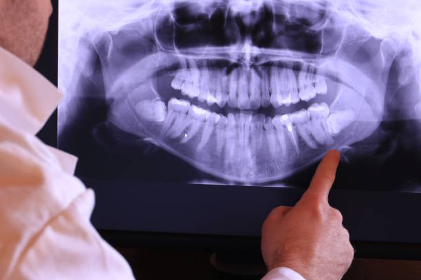Best Knocked-Out Tooth (Avulsed Tooth) Treatment in Prunedale, CA